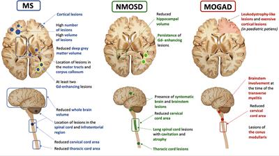 MRI Prognostic Factors in Multiple Sclerosis, Neuromyelitis Optica Spectrum Disorder, and Myelin Oligodendrocyte Antibody Disease